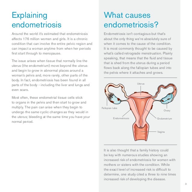 Explaining Endometriosis